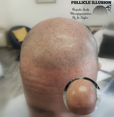 Follicle Illusion-Bespoke Scalp Micropigmentation by Jo Taylor