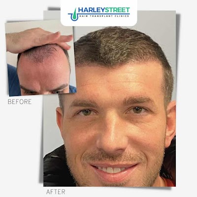 Hair Transplant Leicester